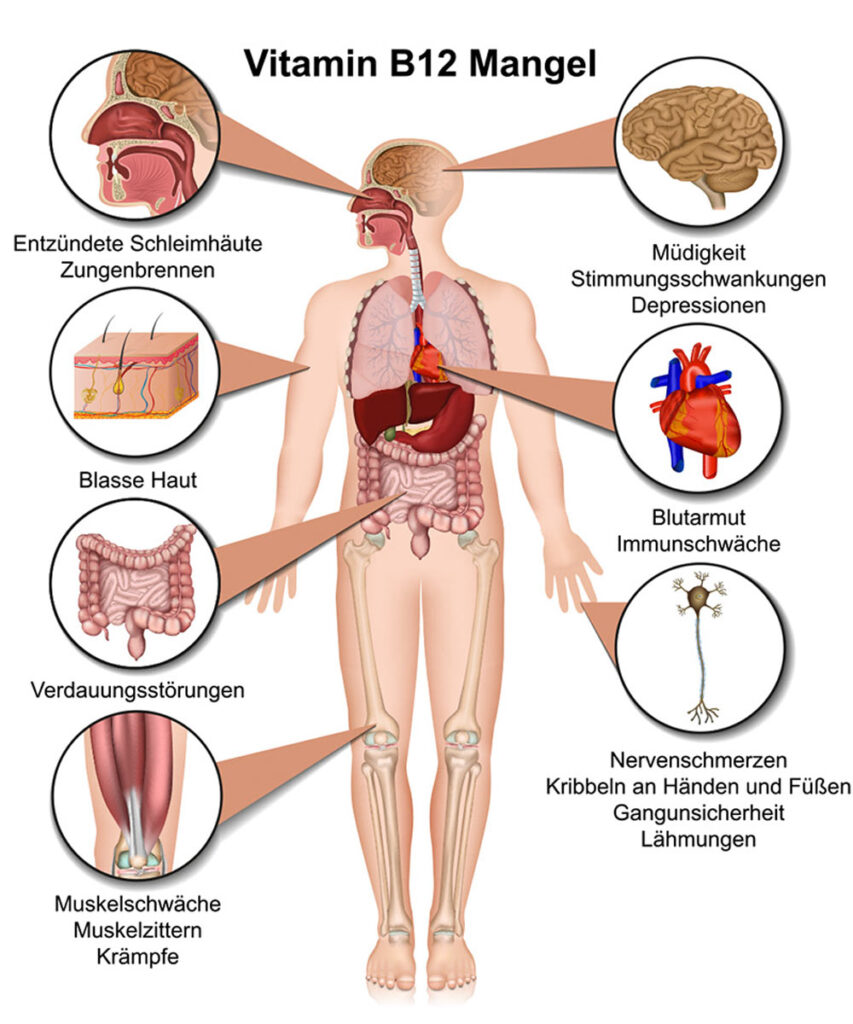 Vitamin B12-Mangelsymptome bei Veganern